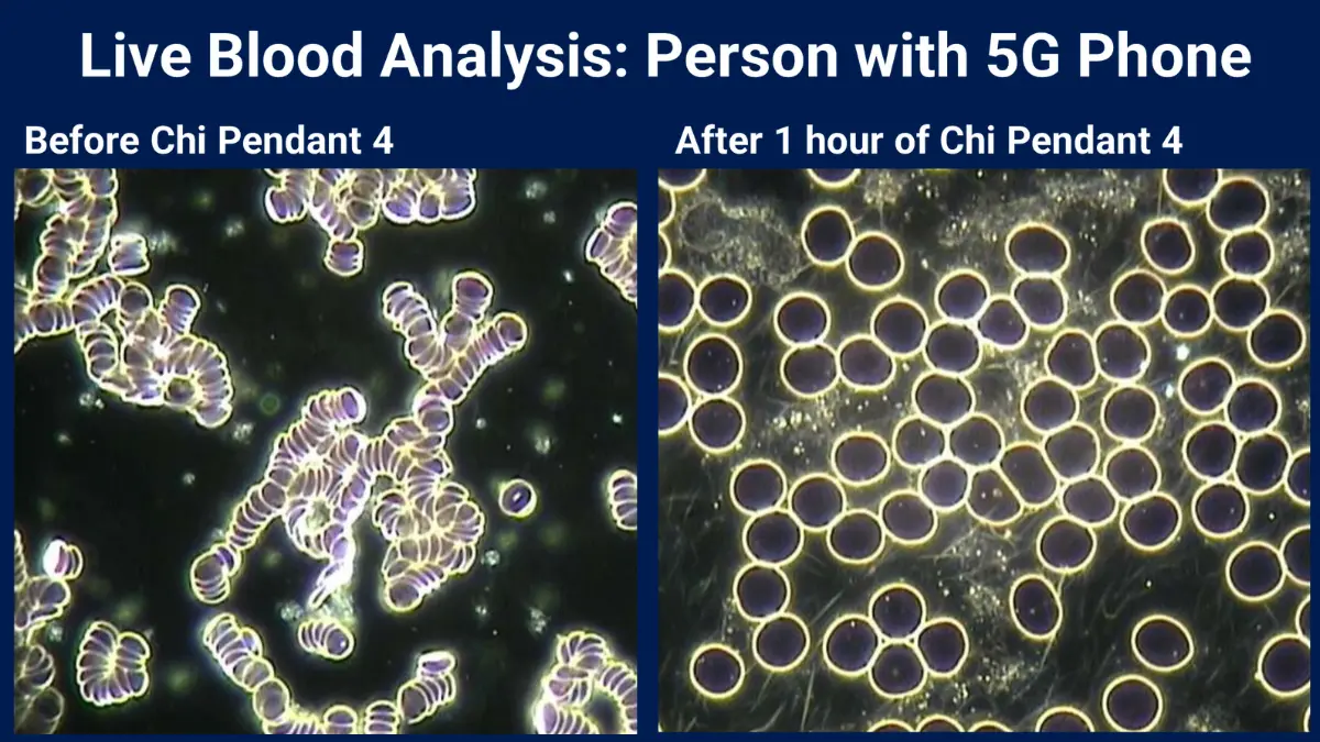 Exploring The Science Behind Amezcua Products 2 Amezcua Science: Live blood analysis of person with 5G phone, before and after using Chi Pendant 4